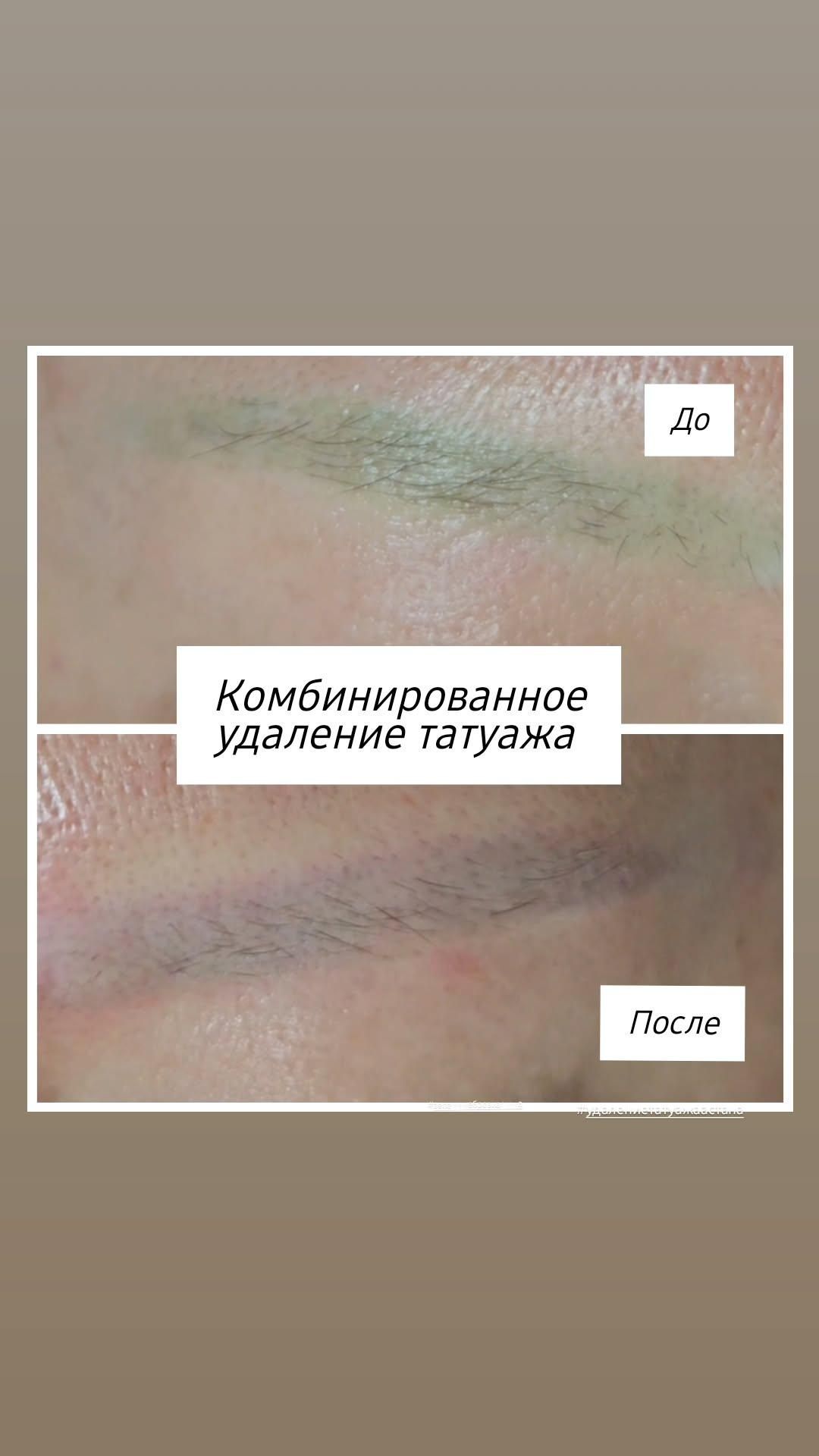 Удаление татуажа и татуировок