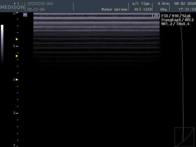 УЗИ сканер SonoAce-X6 (Samsung Medison) с 3 датчиками