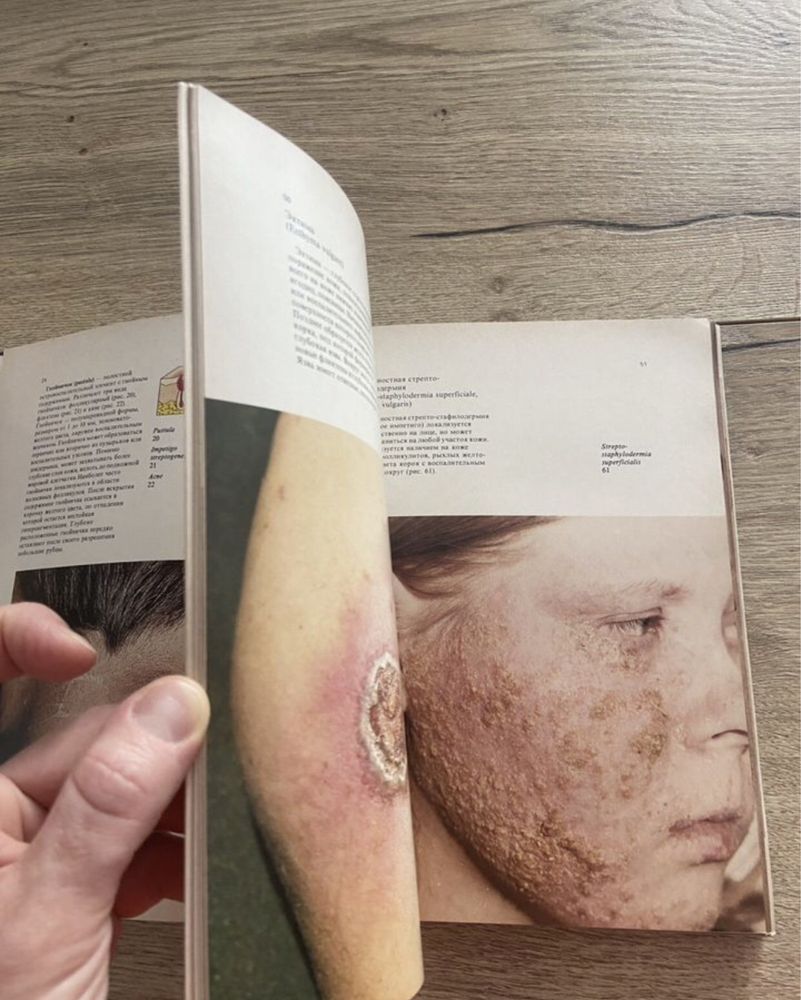 Атлас «Кожные и венерические болезни» В.Владимиров Б.И. Зудин 1980 г