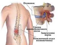 Грыжа, болезни позвоночника, связки, дешего
