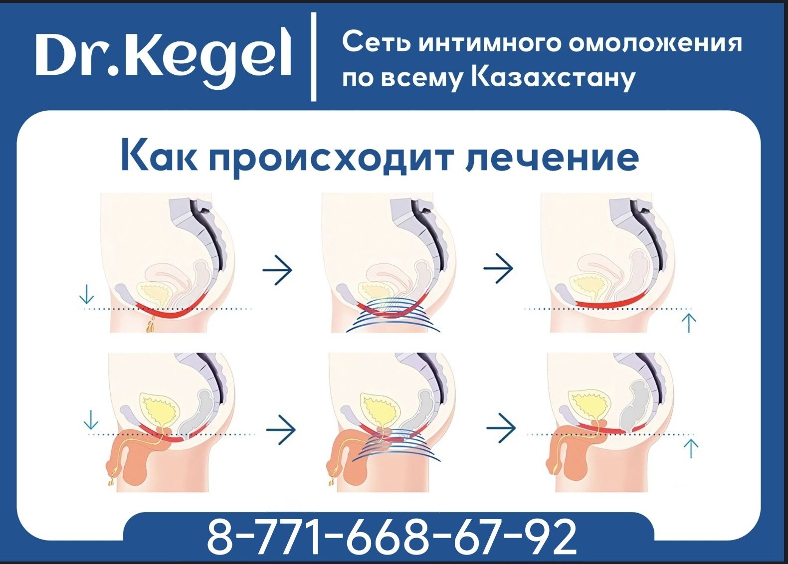 Трон Кегеля Процедура