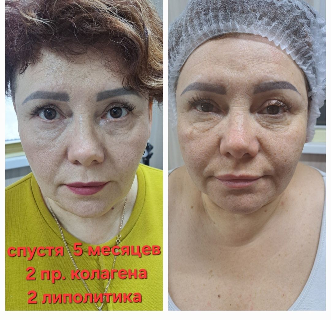 Косметолог  Акция увеличение губ 1 мл 30000тг 
1 мл- 43000тг+  чистка