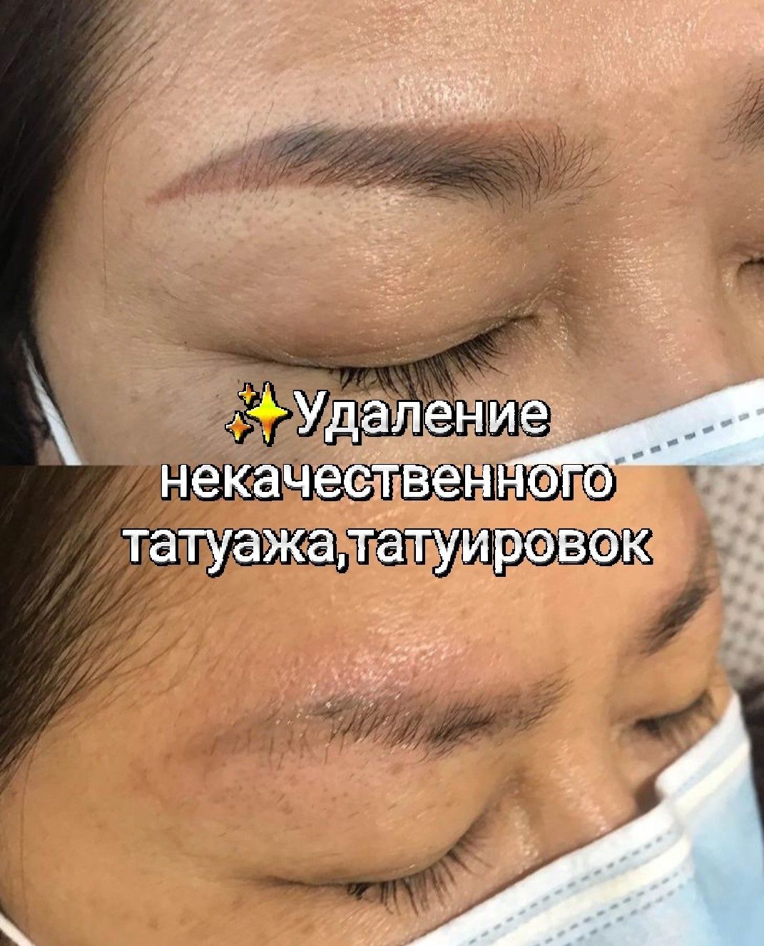 Перманентный макияж/татуаж.Удаление  тату,татуажа.