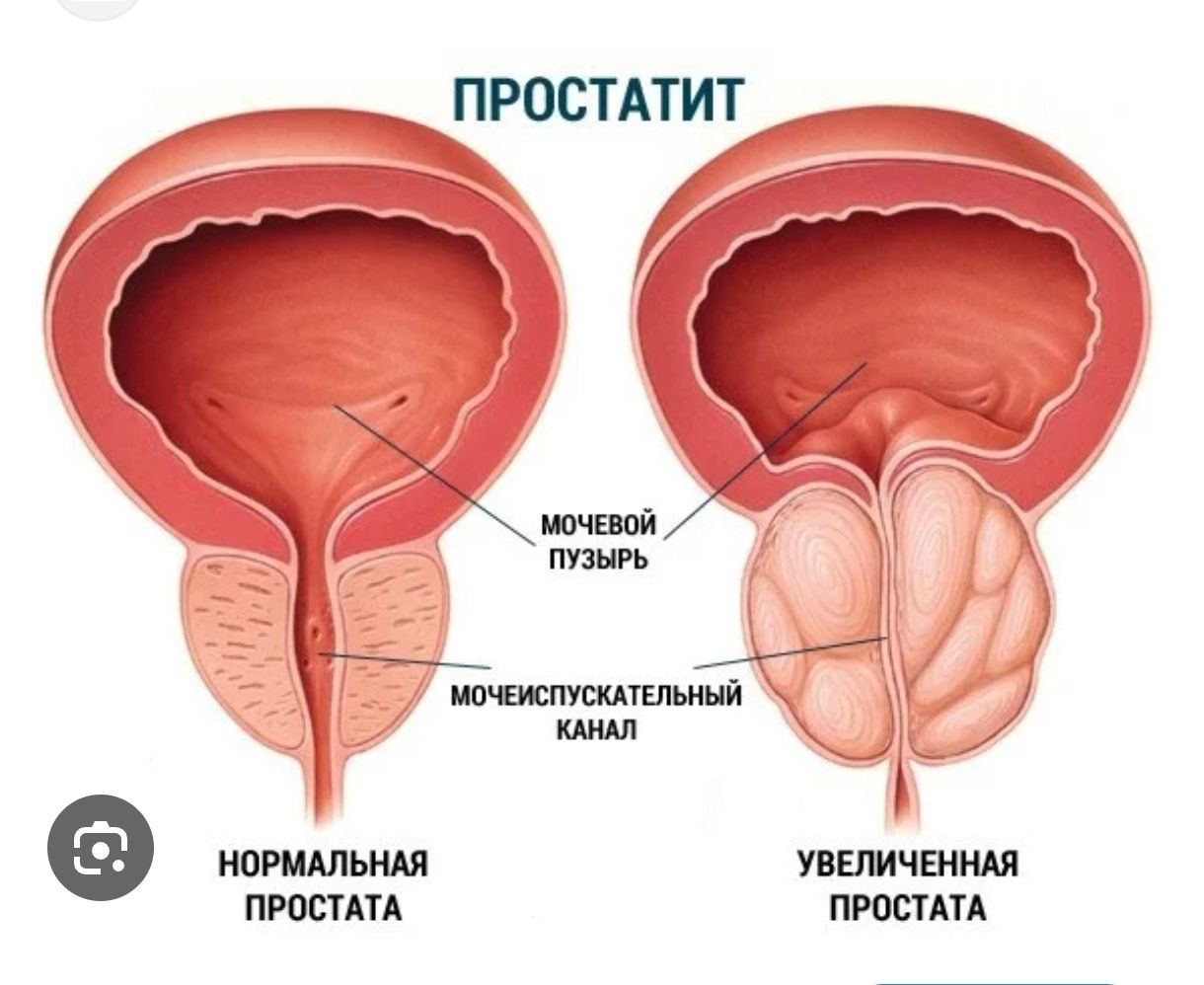 Простатитті массажбен сүлікпен емдеу. гинекологиялық проблемаларға сүл