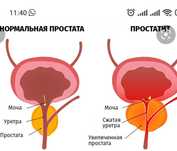 урологически массаж