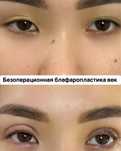 Безоперационная Блефаропластика век нитями