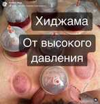 Хиджама. Стаж 30 лет.Гирудотерапия от простатита, Массаж аюрведический