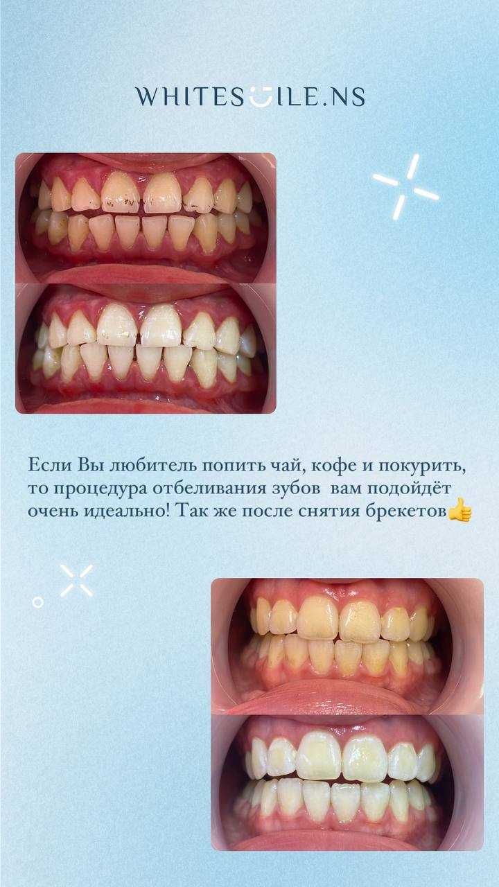 готовый бизнес отбеливание зубов