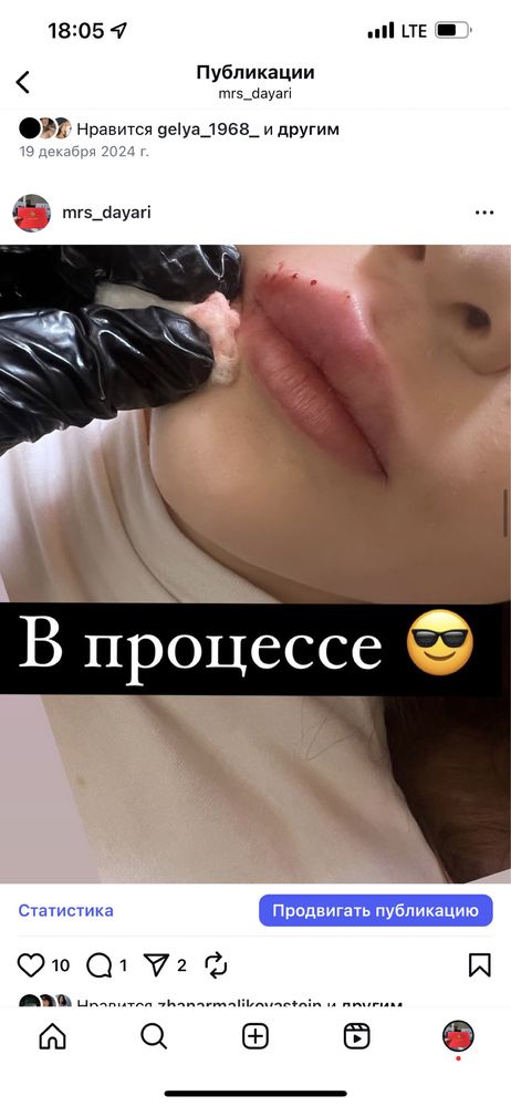 Косметолог . Увеличение губ