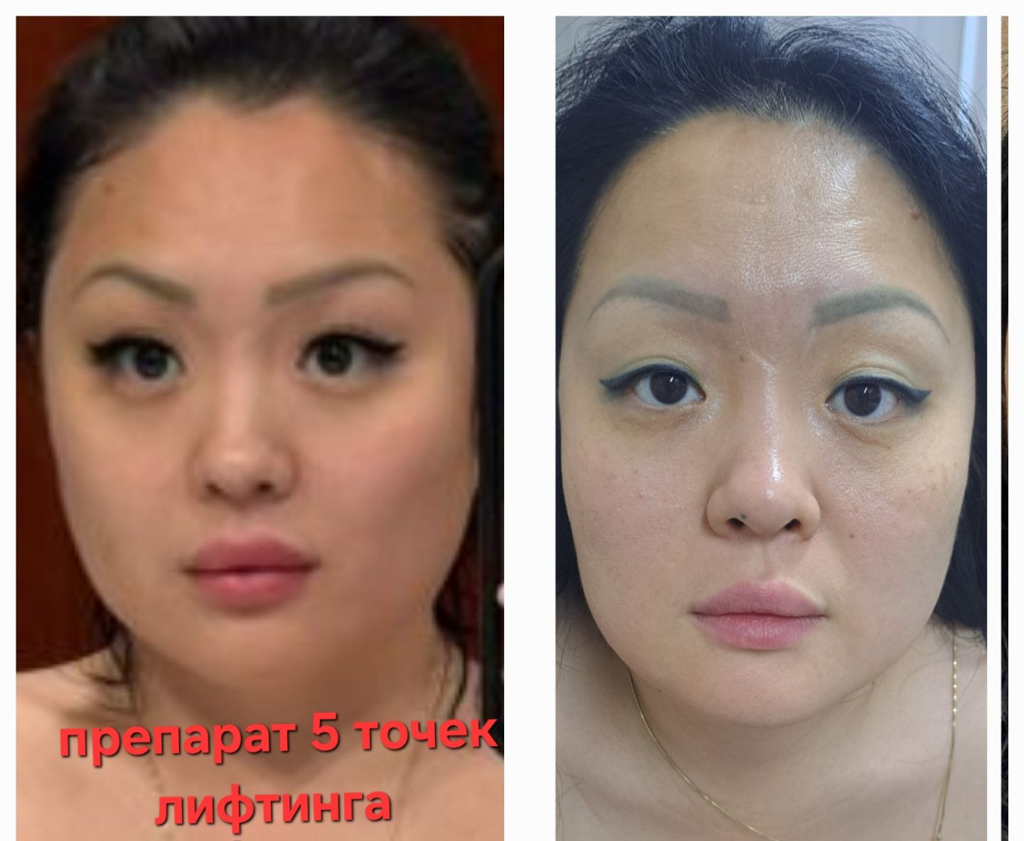 Косметолог,  чистка,ботокс,  губки, г. Алматы