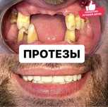 Протезы. Съёмные протезы. Зубные Протезы.  Стоматология протезы