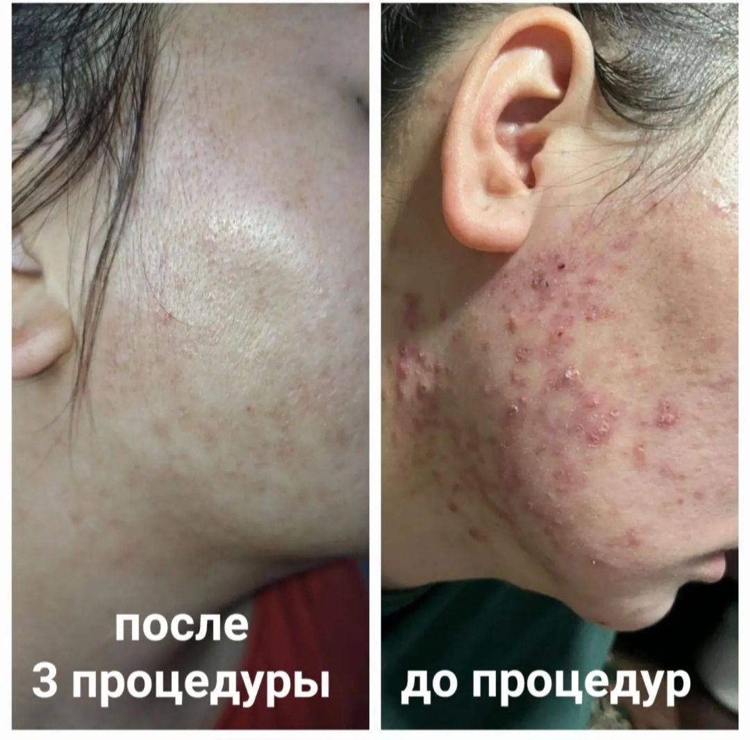 Косметолог  Акция увеличение губ 1 мл 30000тг 
1 мл- 43000тг+  чистка