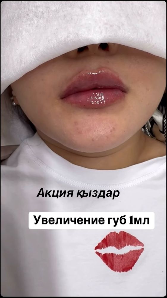 Нитевая блефаропластика ШЫМКЕНТ