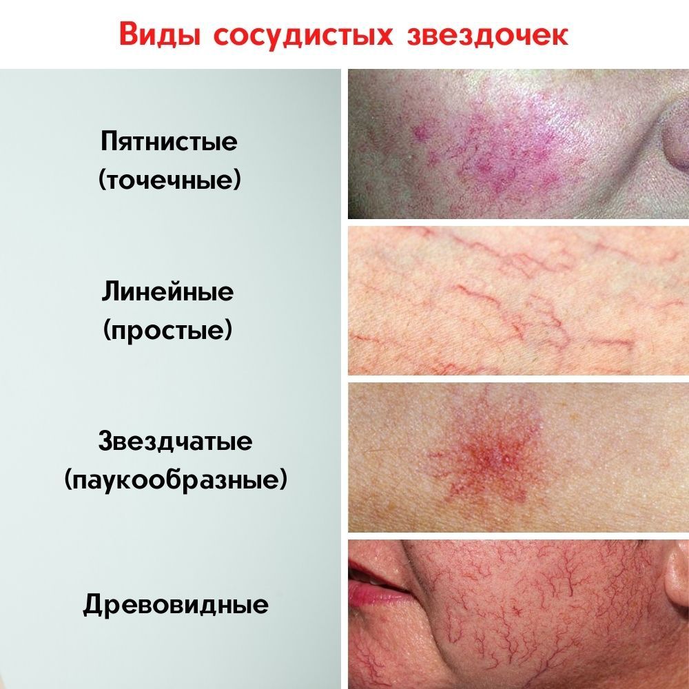 Диодный лазер. Удаление сосудов на лице и теле. Лучший аппарат для соб