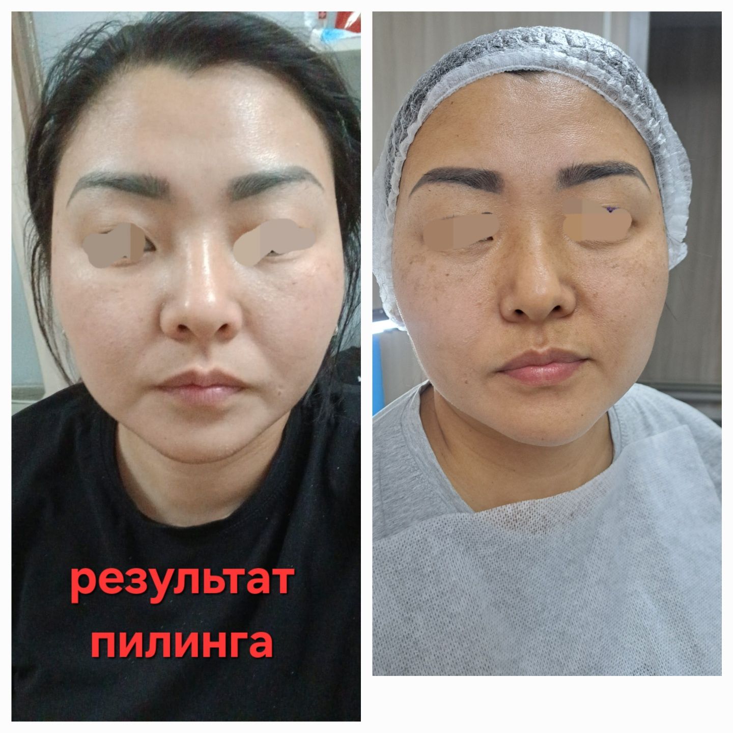 Косметолог  Акция увеличение губ 1 мл 30000тг 
1 мл- 43000тг+  чистка