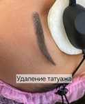 Лазерный удаление татуаж татуировки