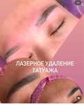 Лазер от4500 (произ-твоРоссия) Лазерноудаление татуажа,тату,ремувером