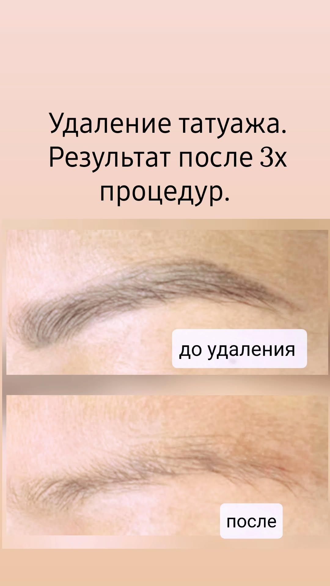 Удаление татуажа и татуировок