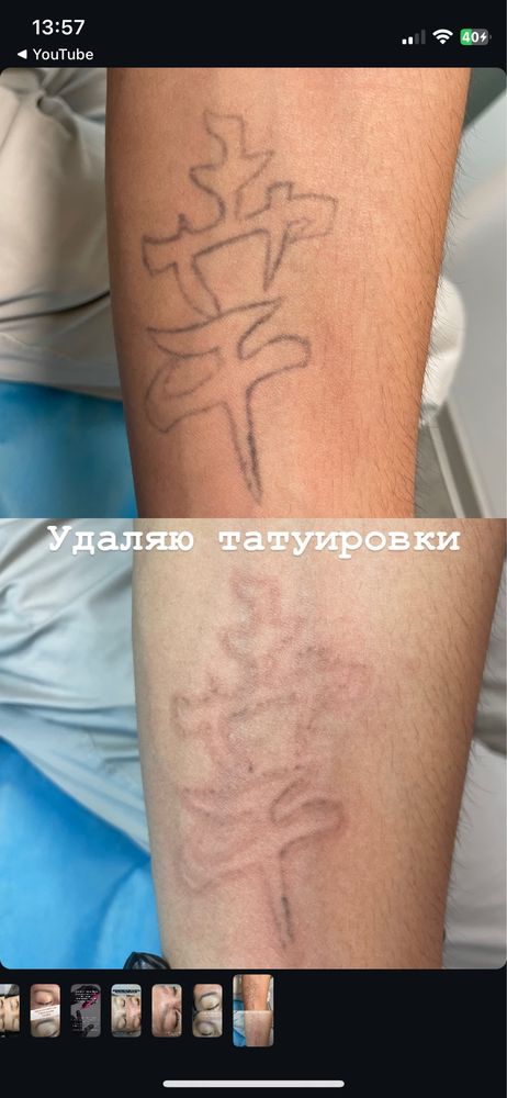 Удаление тату и татуажа