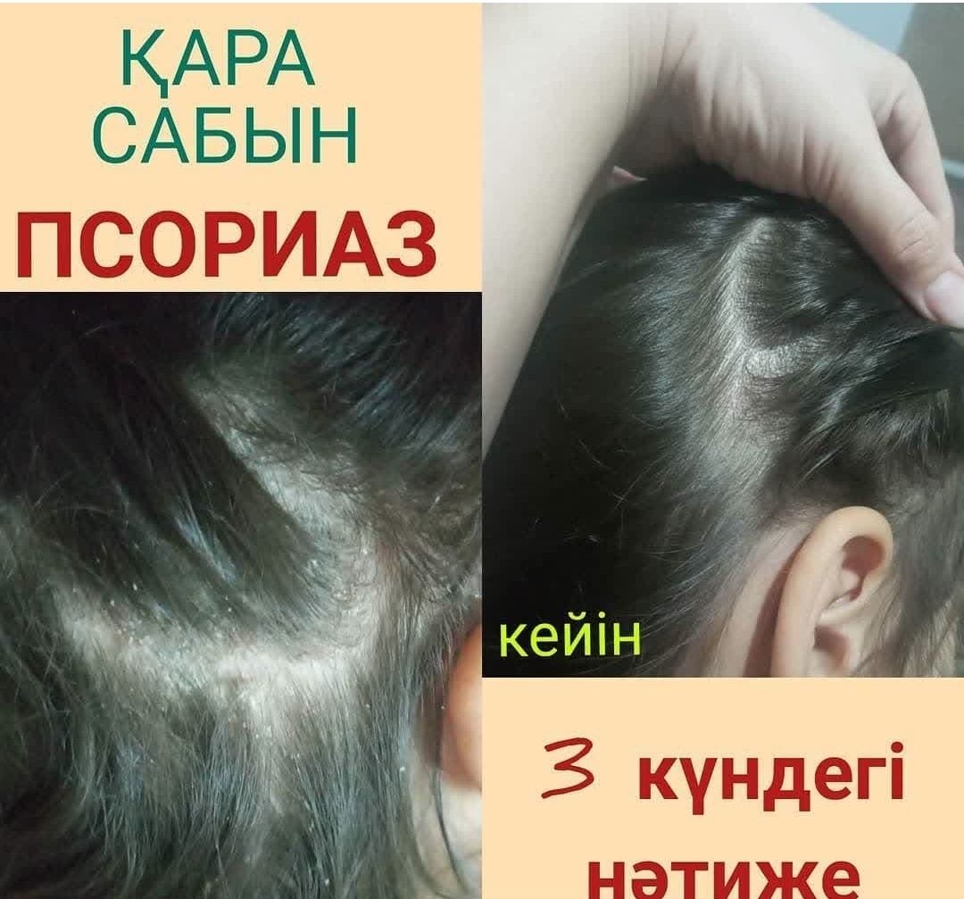 ҚАРА САҚАР сабын тері ауруларына таптырмас ем
