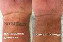 Удаление татуажа татуировки ремувер лазер брови губы стрелки