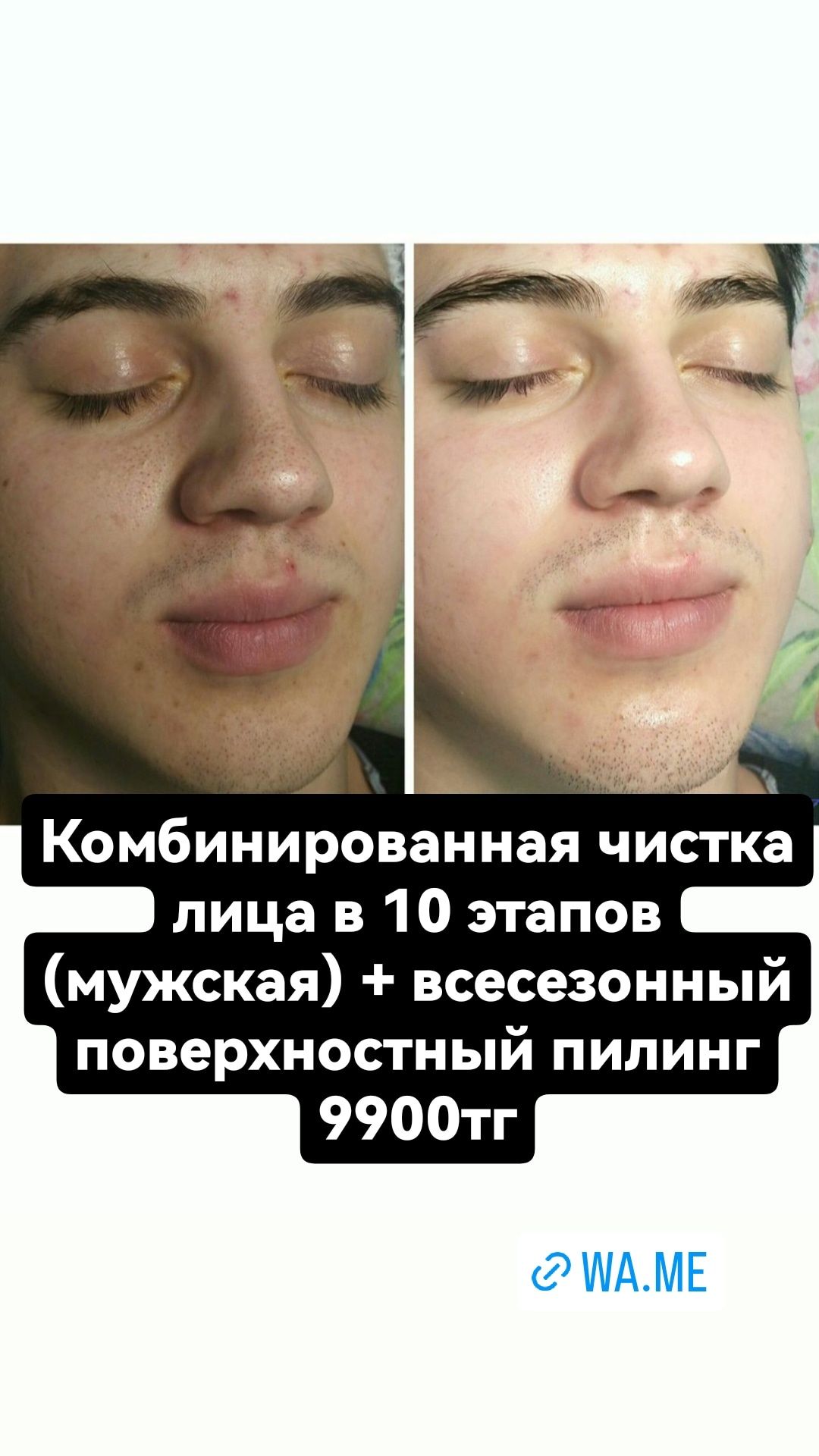 Акции на чистку лица, чистку спины!