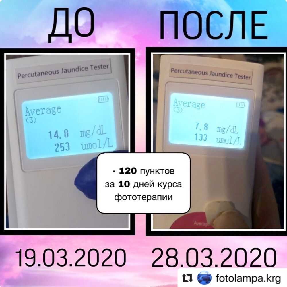 Замер анализ определение билирубина билитест фотолампа биллитест лампа