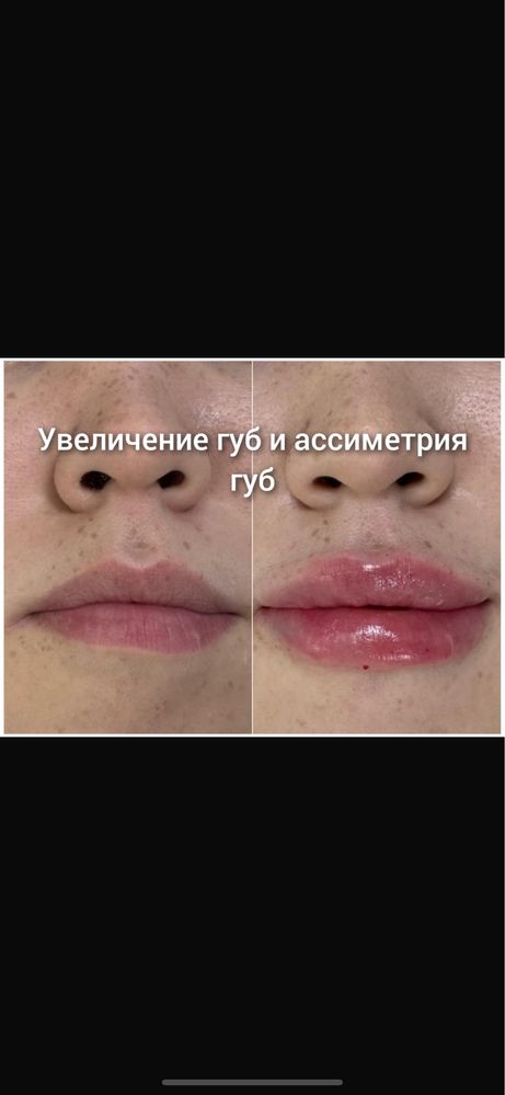 Шок цена! Акция! 18.000тг.Цена актуальна на 7 дней! На Увеличение губ!