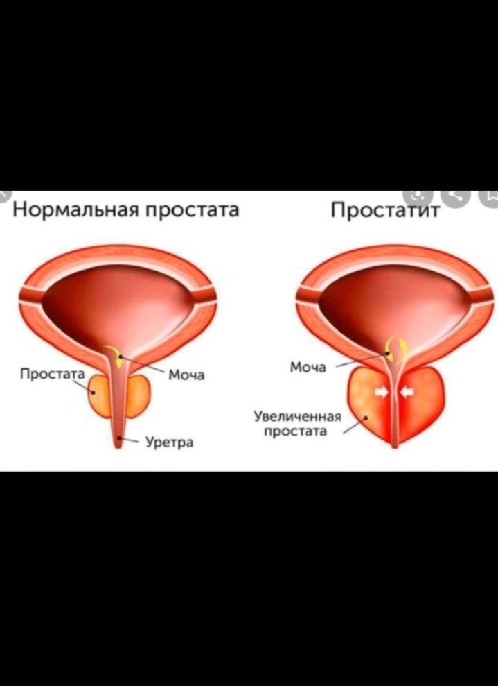 Алтын қоңыз, алтин кониз, простатит, майский жук,уролог