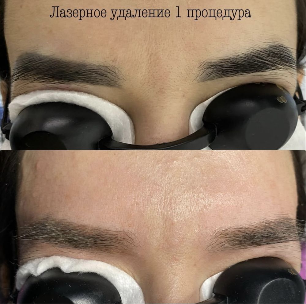 Удаление тату и татуажа