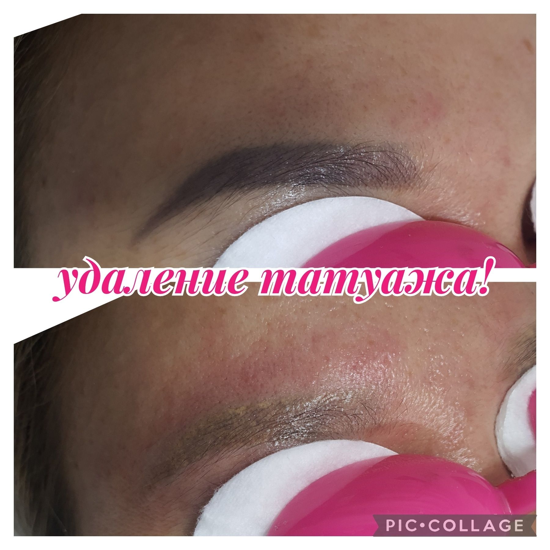Удаление татуажа и тату лазером