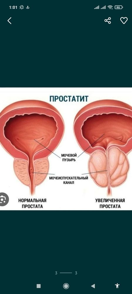 Урологический массаж простаты для лечени и прфилактики 10.000 т