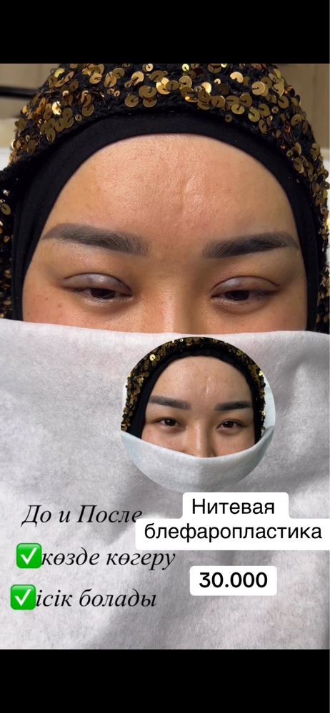 Нитевая блефаропластика ШЫМКЕНТ