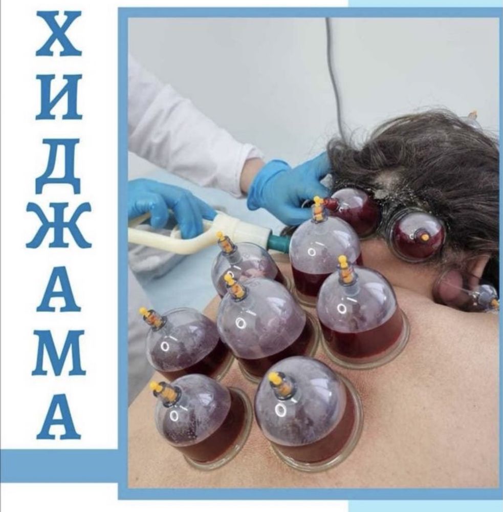 Хиджама. Шертпе. Кровопускание