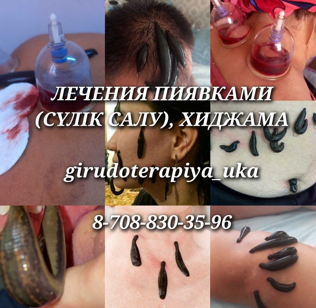 Лечения пиявками