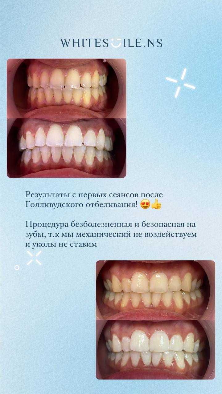 готовый бизнес отбеливание зубов