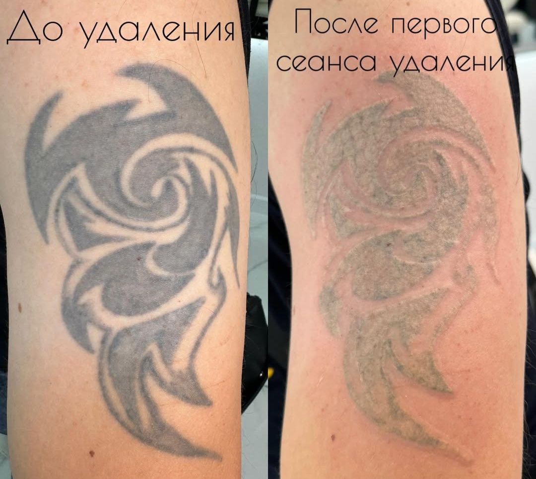 Лазерный удаление татуаж татуировки