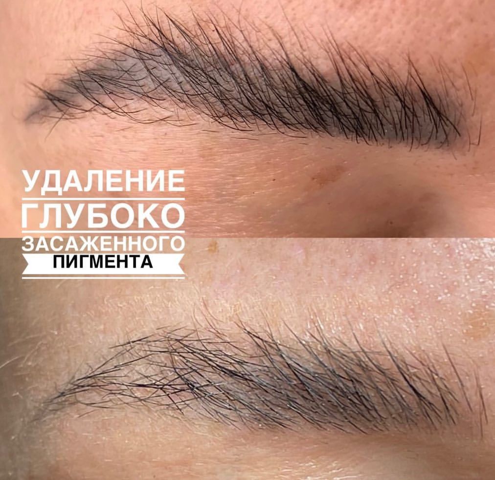 Удаление татуажа ремувером Безболезненно