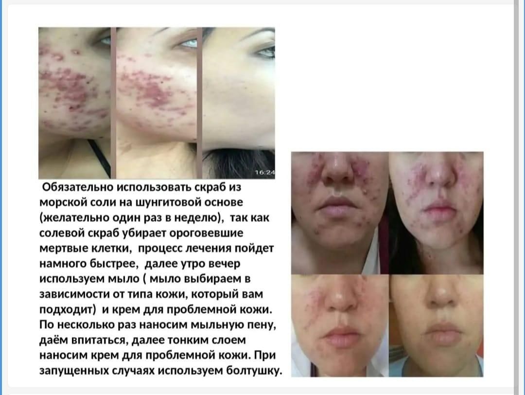 Шунгитовое мыло двух видов на страже вашего здоровья.