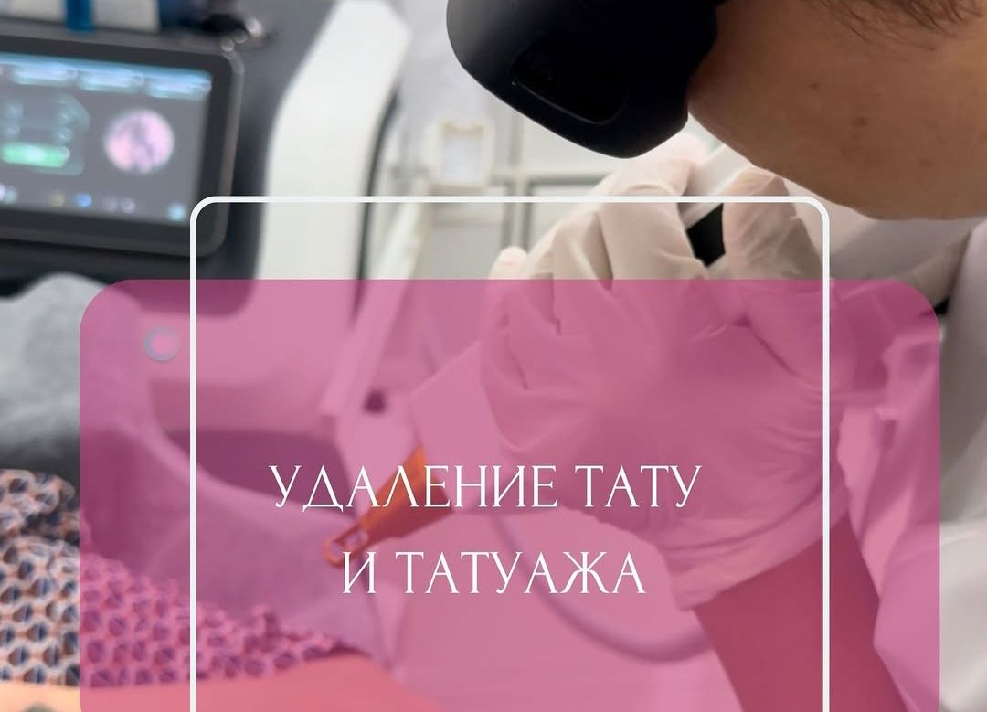 Лазерный удаление татуаж татуировки