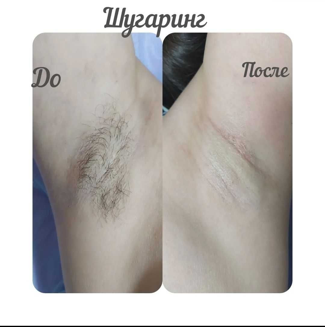 Обучение по Шугарингу по АКЦИИ
