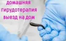 Гирудотерапия, пиявки