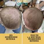 Ортопедический шлем для лечения деформации головы
