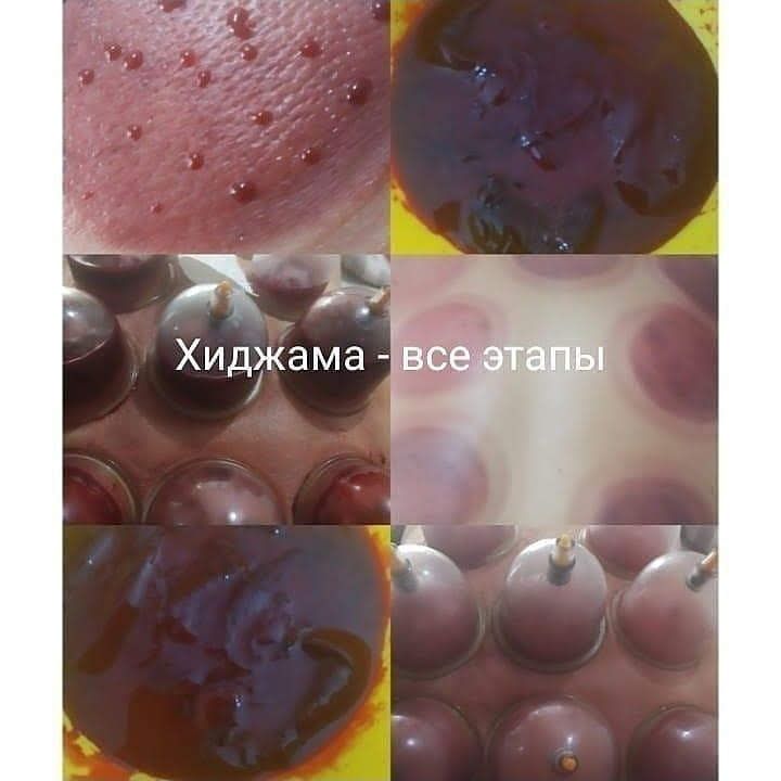 Хиджама для оздоровления и омоложения