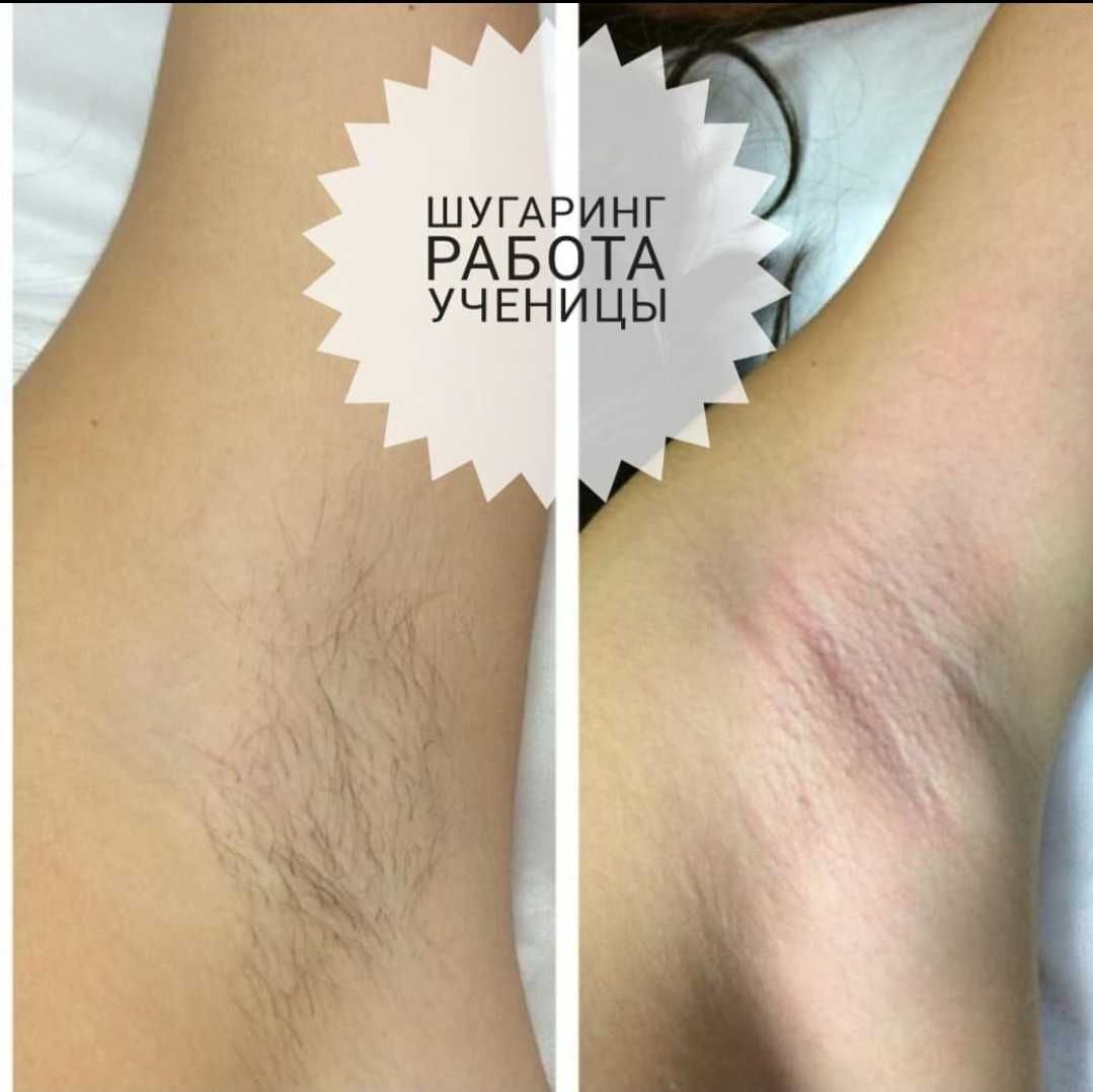 Обучение по Шугарингу по АКЦИИ