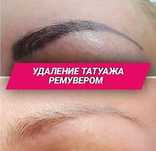 Удаление татуажа