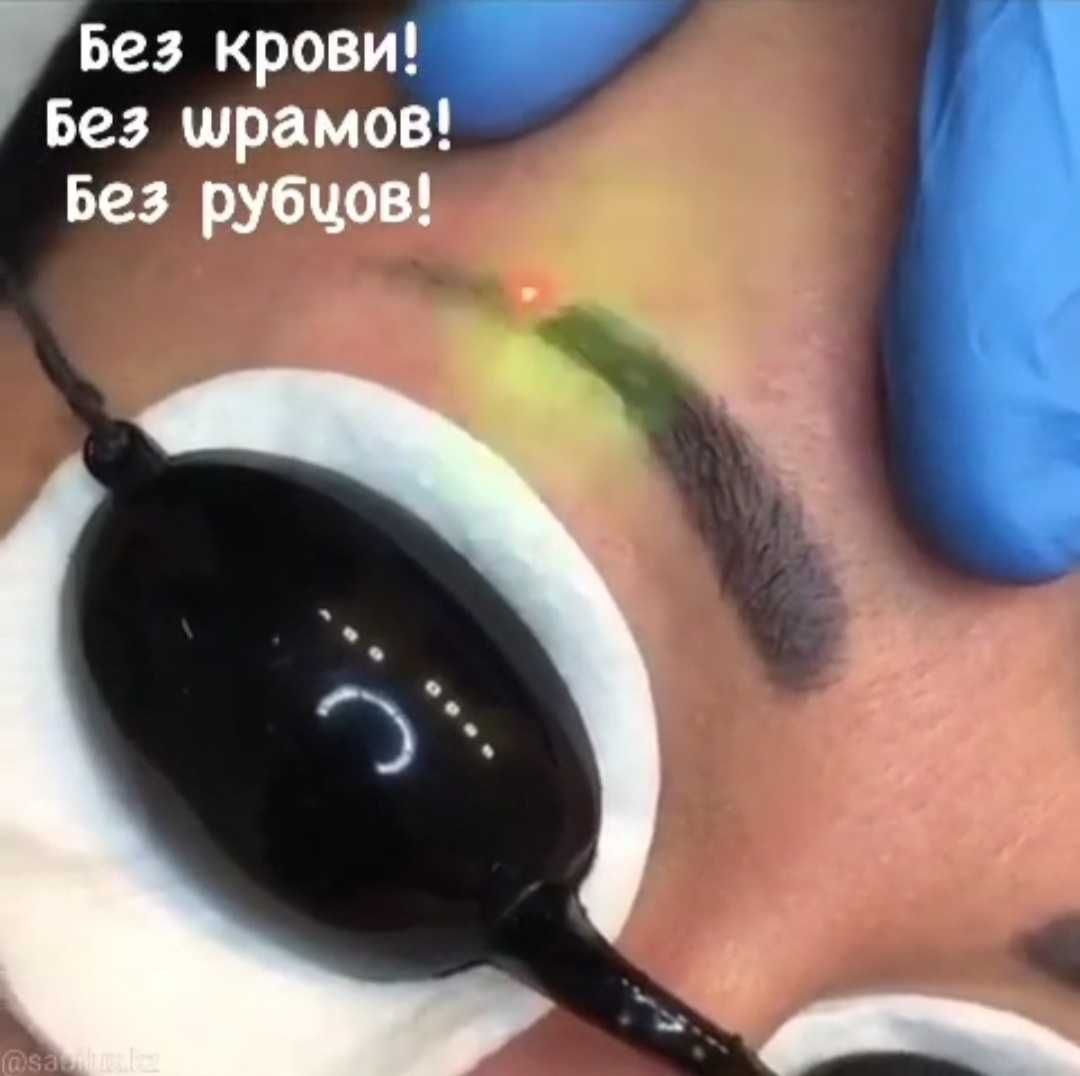 Лазерное удаление тату и татуажа