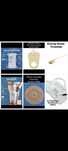 Coloplast Alterna пластины, уростомные мешки, Apexmed бандаж и т.д.