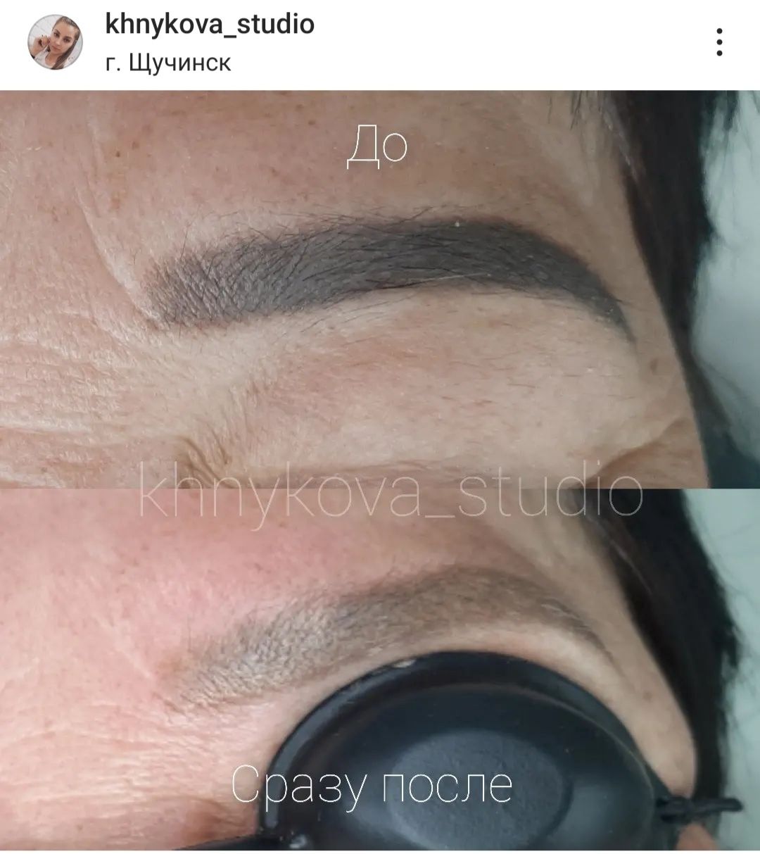 Удаление тату и татуажа