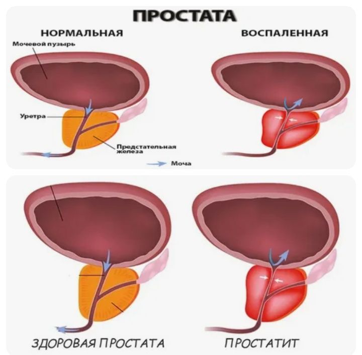 Забота о простате